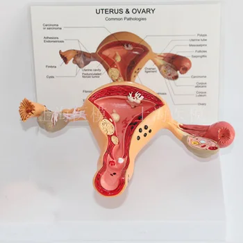 MATERNICA &VAJEČNÍK bežné ochorenie Maternice Choroby Vaječníkov ochorenia Vaječníkov anatomický model Pôrodníctva a Gynecology